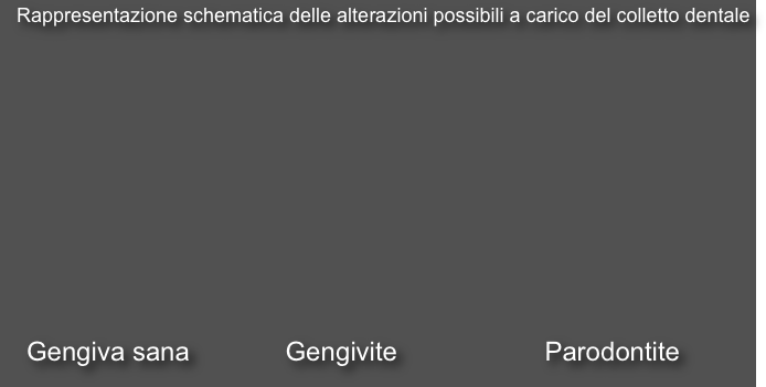   Rappresentazione schematica delle alterazioni possibili a carico del colletto dentale










   Gengiva sana             Gengivite                    Parodontite