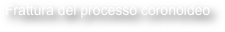 Frattura del processo coronoideo